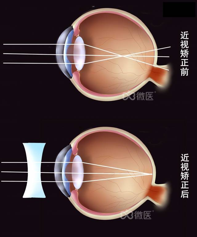 其实,近视手术的原理,同佩戴框架眼镜,隐形眼镜是一样的.