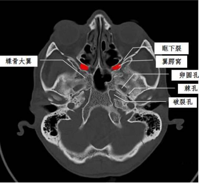 后内:翼管-破裂孔 后上:圆孔-颅中窝 后下:腭鞘管-鼻咽 蝶骨大