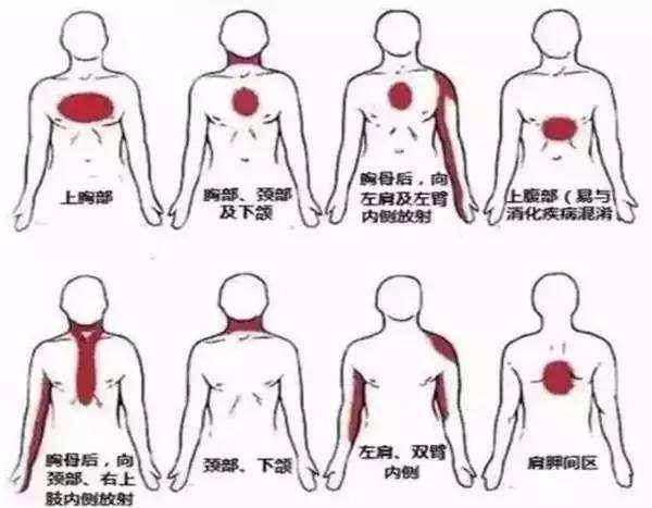 53岁,1个月前刚做过心脏造影,今天突发心脏病死亡,原因简单