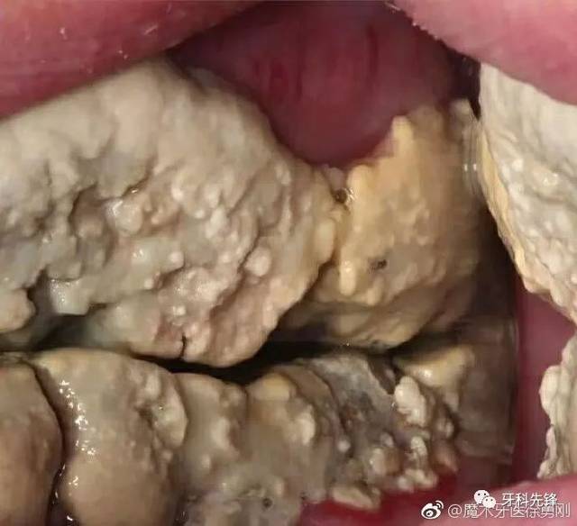 多年不洗牙,牙结石堆成钟乳石!是时候放下对洗牙的了!