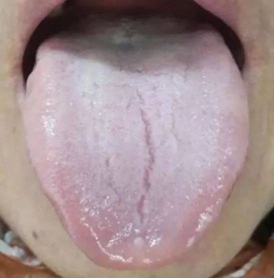 主要是阳虚阴盛,阳不化气,面色及皮肤都可见晄白无华, 但以舌体最明显