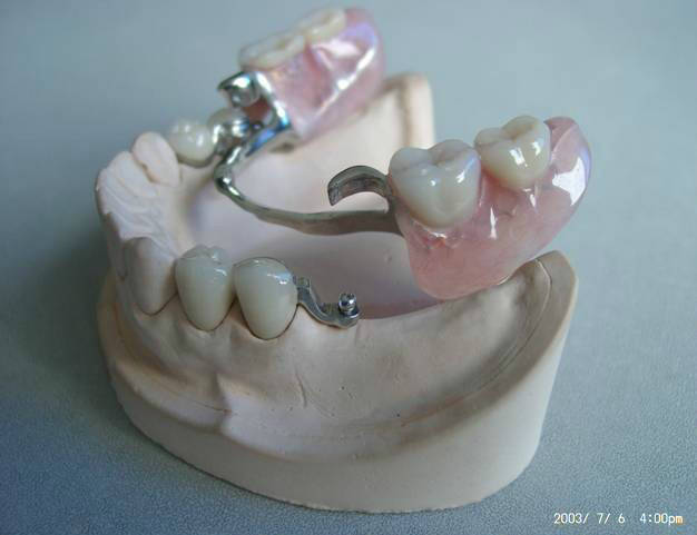 在可摘局部义齿治疗,牙支持和种植体支持的覆盖义齿病例中