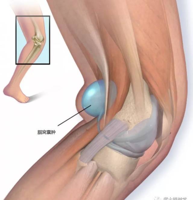 髌骨恐惧试验(patellar ap22 前膝关节疼痛 髌骨软骨软化被用作前膝