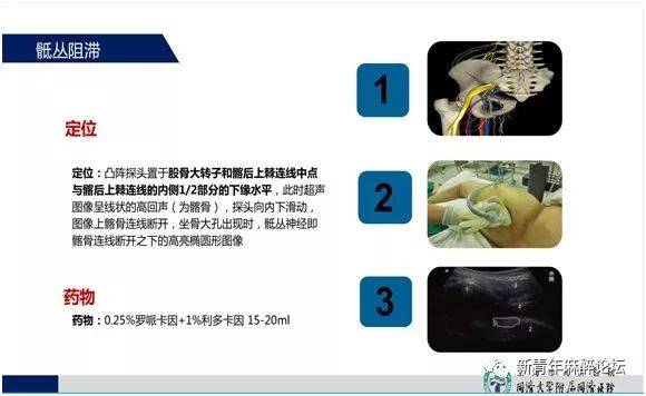 由一分钟骶丛阻滞说开去