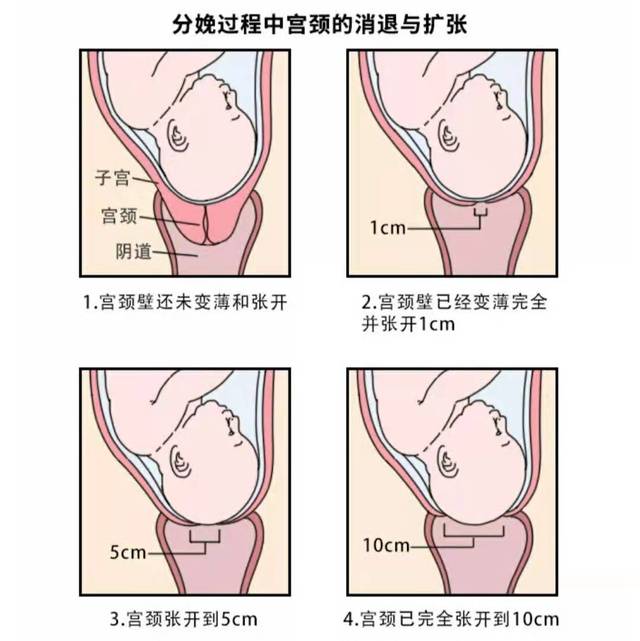 在子宫口打开的过程中,宫颈壁会逐渐变薄,然后张开1厘米,2厘米,3厘米