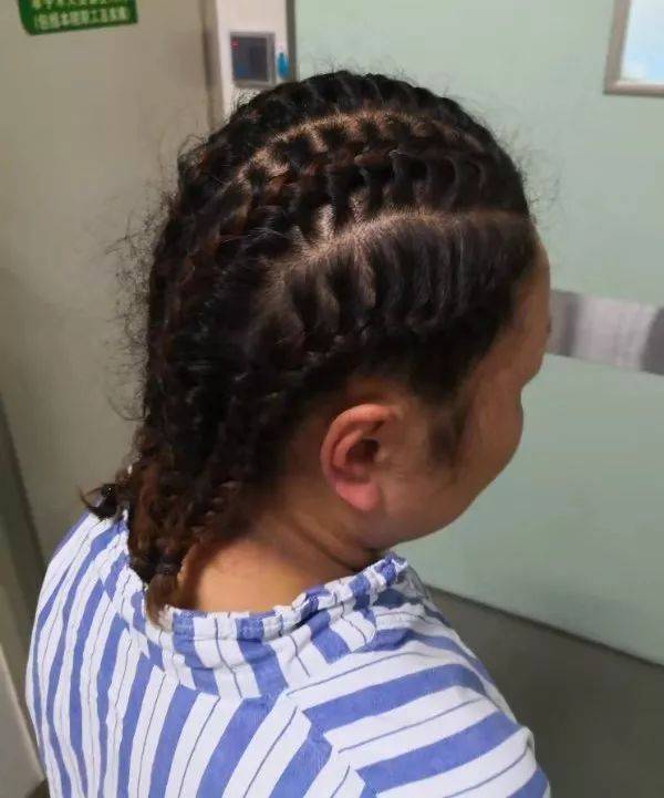 "当听到彭医生这样一说,感觉方案很周全,既能留住头发又能把手术做了