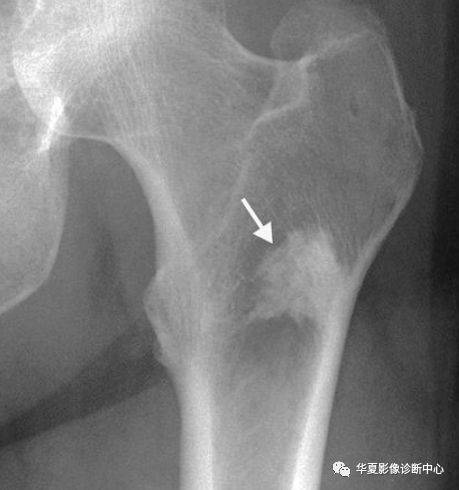 【影像基础】骨岛的影像诊断及鉴别诊断