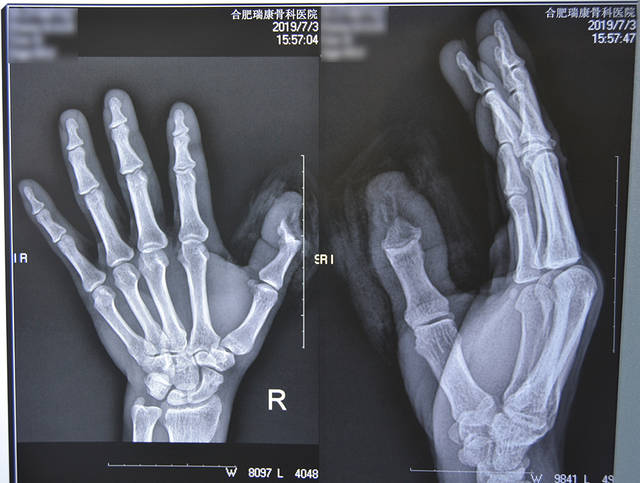 男子手指缺失 显微手术"移花接木"再造新拇指