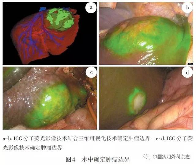 指南与共识|计算机辅助联合吲哚菁绿分子荧光影像技术