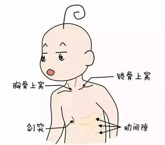所谓三凹,就是胸骨上窝,锁骨上窝和肋间隙在呼吸时向内凹陷.
