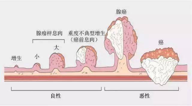 癌变率确实很高,如大肠腺瘤性息肉已经被视为癌前病变,而腺瘤性胃息肉