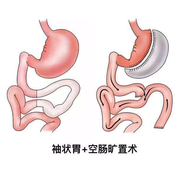 袖状胃切除术术加空肠旷置术的减肥原理是什么?