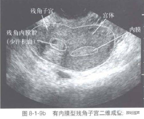 子宫形态异常及子宫内膜周期性变化