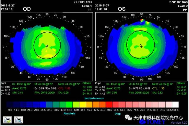 天津市眼科医院视光中心病例:高度近视患者配戴角膜塑形镜的效果观察