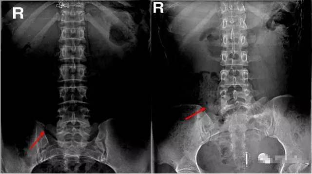 一:骶椎未完全腰化,无椎间盘 骶管裂孔变异 骶骨后面下部有一缺损