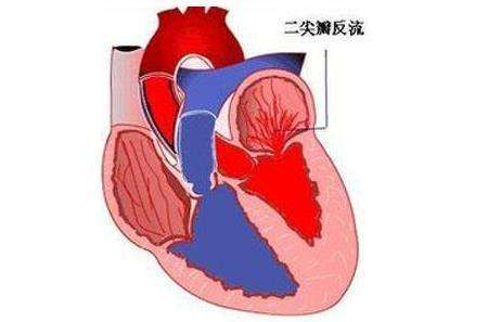 重磅!中国首部二尖瓣反流介入治疗规范共识 正