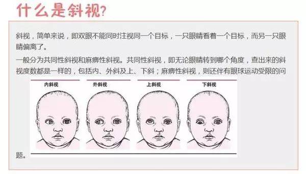 常见的斜视表现——眼位偏斜：内斜视：俗称“斗鸡眼”，眼位向内偏斜；