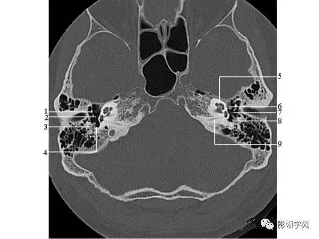 锤骨颈 6.外耳道 7.蜗窗 8.面神经管乳突段 9.颈静脉窝图1-11.
