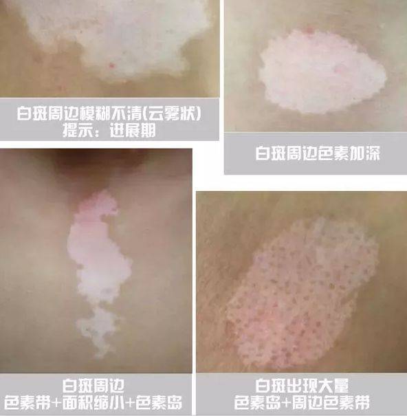 白斑边界模糊,到底是要发展还是好转?