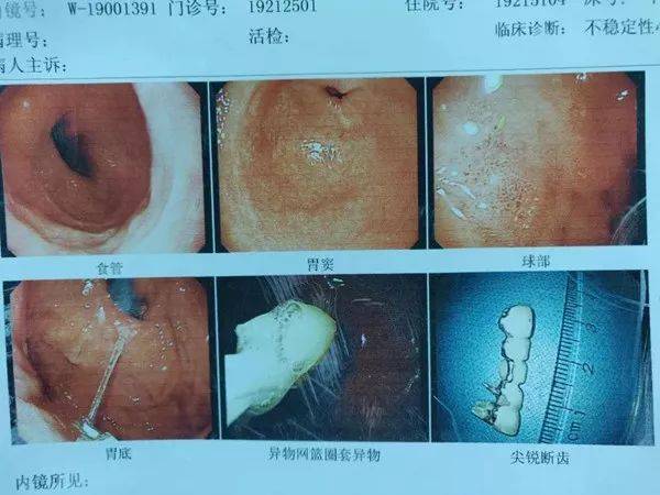 老人晕厥抽搐,5颗假牙卡在食管,险些丧命!幸好