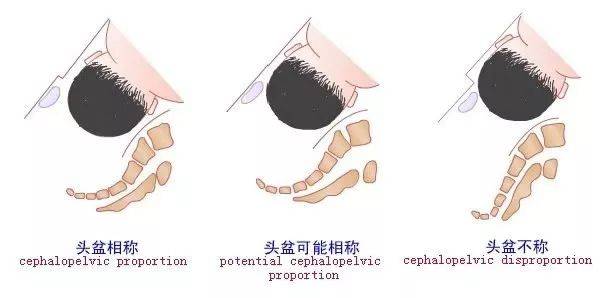 如果临产时胎头尚未入盆,则有头盆不称可能.