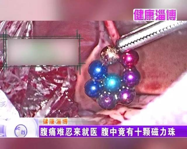 十颗磁力珠下肚 一岁多娃娃"开肠取物"!