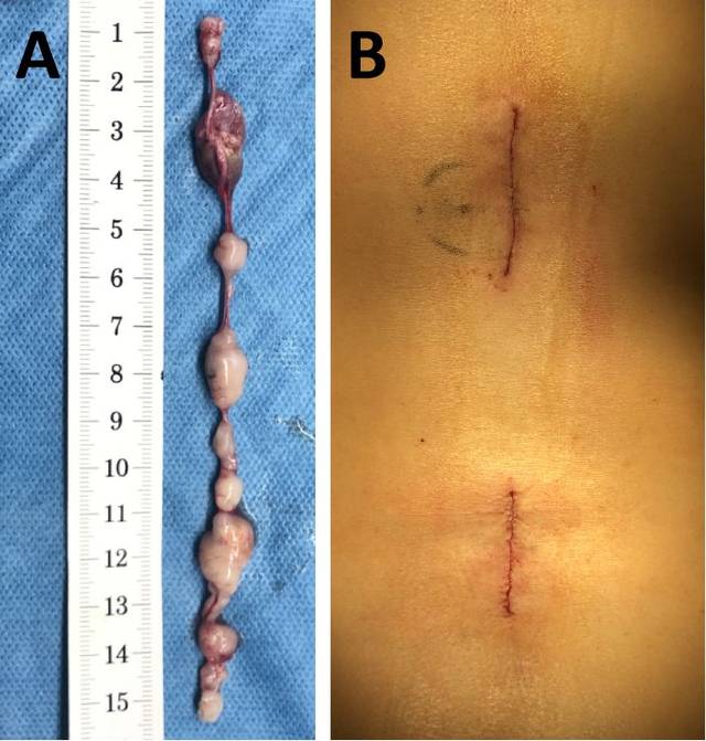 显微镜结合内镜切除马尾"十连珠"神经鞘瘤一例(脊柱脊髓系列二)---浙