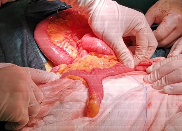 马晶晶副主任医师介绍小肠出血的病因很多,由于小肠的特殊解剖结构所