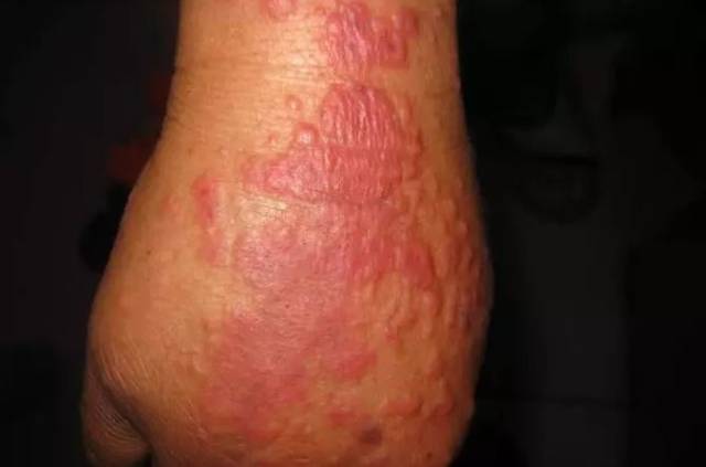 红斑型:皮疹为大小不等,边界清楚的红色或暗红色水肿型丘疹,边缘稍