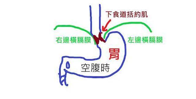 基本上这样的患者本身下食道括约肌的力量以及长度都没有问题,也没有