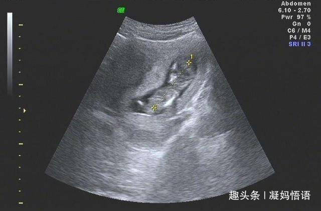 怀孕3个月,看懂B超单上这两个数据,胎儿就没有