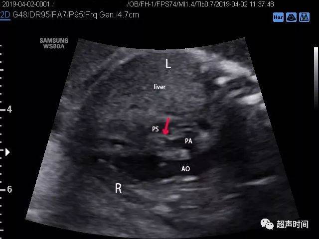 「钰」你谈心:胎儿右室双出口