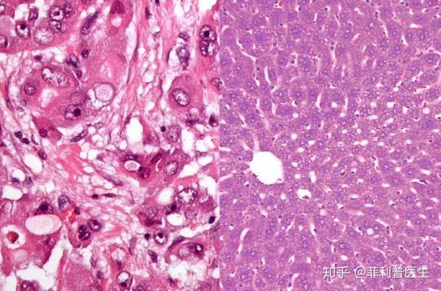 细胞大小,形态异常;右:正常肝组织切片—肝小叶正常结构存在,细胞