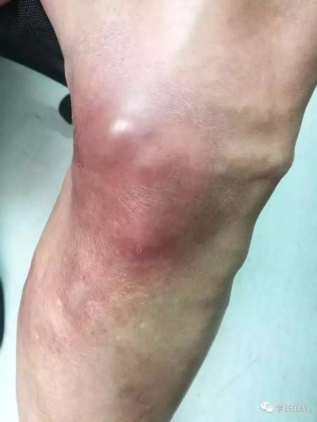 挤火疖子引发致命肺栓塞北大医生腿上这种包千万不要挤
