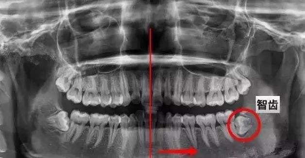 横着长的智齿必须拔