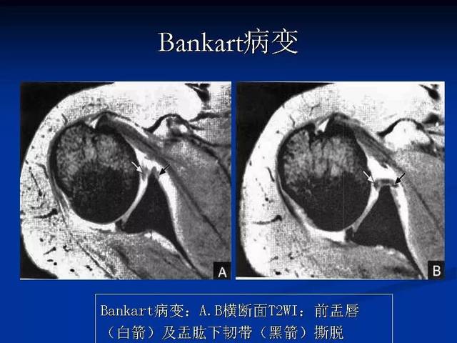 肩关节盂唇损伤的mri诊断 | 影像天地