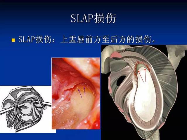 肩关节盂唇损伤的mri诊断 | 影像天地