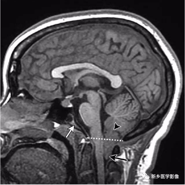 图 11 为1岁儿童正常的颅咽管结构,外伤后的检查中常常会误诊为骨折