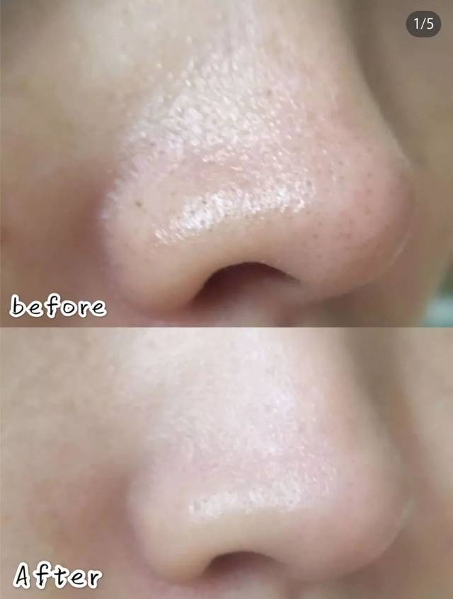 别再挤黑头了!今天教你只用一招,轻松摆脱难看