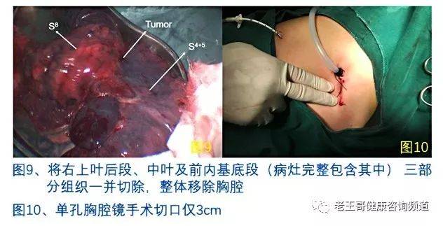 拿什么拯救你的肺功能—单孔胸腔镜精准肺段(联合亚段)切除术