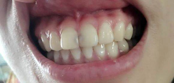 骨性龅牙:上颌骨发育过度的突为"骨性"前突,上前牙倾斜幅度不大