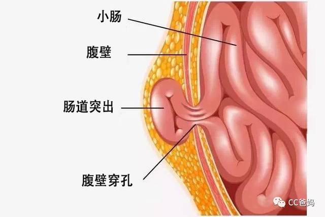 疝气的主要原因是由于 宝宝腹壁的某个位置没有发育好 存在腹壁肌肉