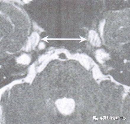 【温故知新】梅克尔(meckel)腔的影像解剖及临床意义