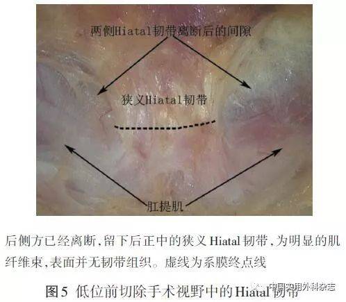 讲座|hiatal韧带解剖研究的临床意义和应用