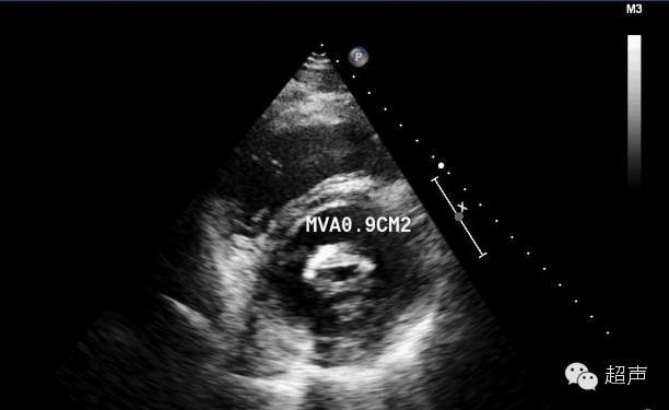 二尖瓣狭窄超声特点