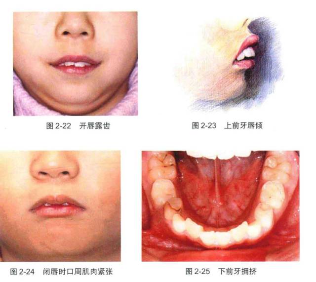 上唇系带附着过低,过粗可能会导致上前牙间隙出现. 舌体与错颌畸形