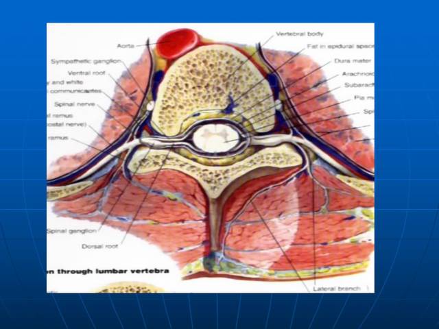 x线片示经椎体,椎弓根,椎板及棘突拉长的影像. 4 牵拉伸展型