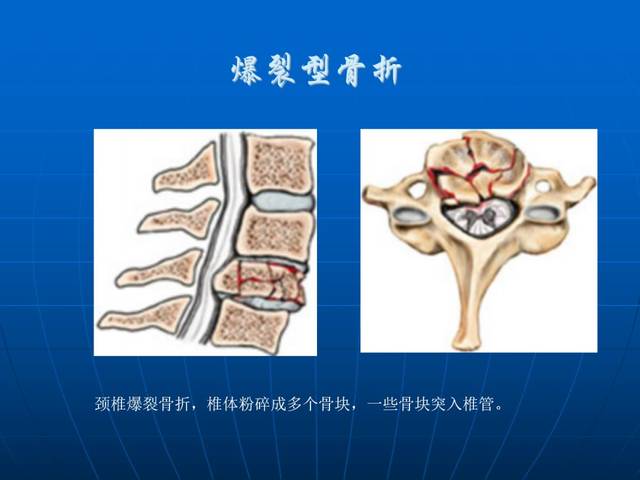 进阶必读 脊柱骨折与脊髓损伤概述