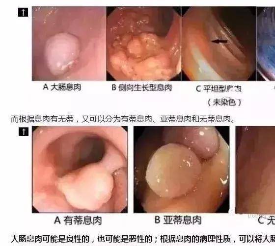 肠息肉摘除后会不会再长?多长时间复查