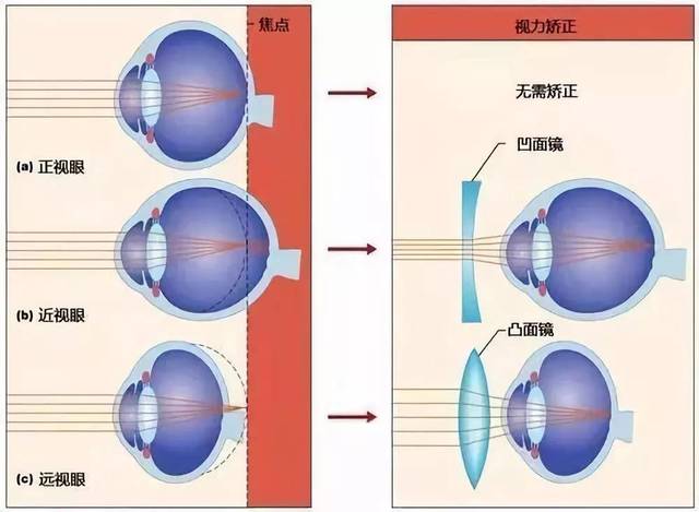 这也是为什么近视和远视都需要一直戴着眼镜,而老花眼只在看近景时